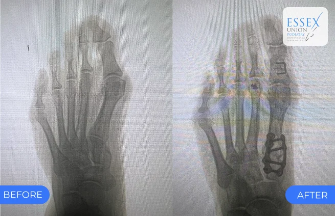 Lapiplasty bunion correction X-ray — before and after results at Essex Union Podiatry