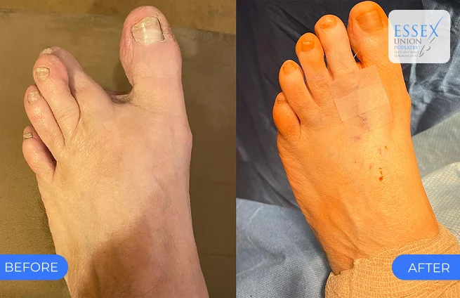 Plantar plate repair — before and after results at Essex Union Podiatry