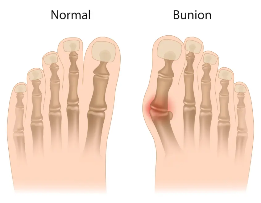 Can Bunions Be Corrected Without Surgery?