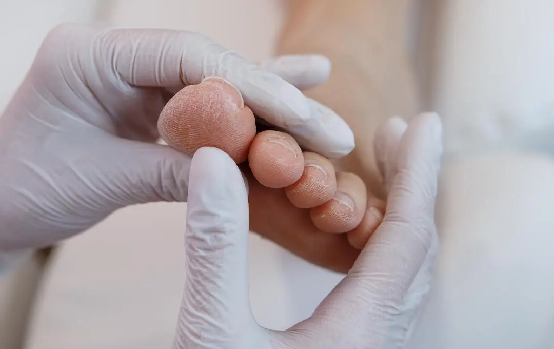 Can A Podiatrist Remove Dead Skin?