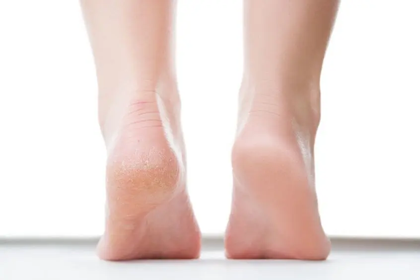 How Do Podiatrists Remove Cracked Heels?