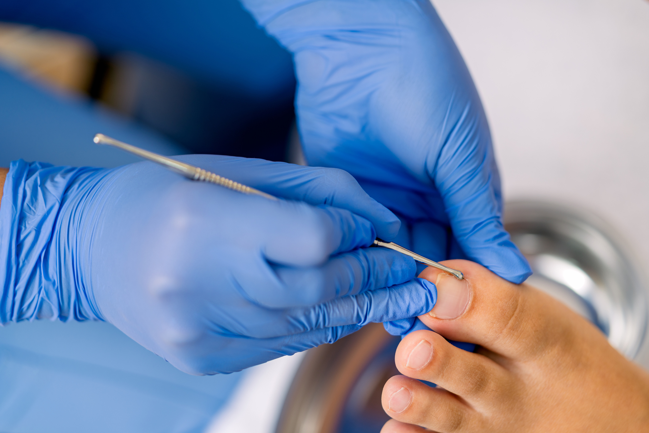 Ingrown Toenail Removal at Essex Union Podiatry